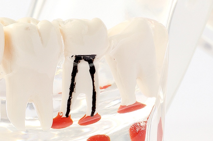 歯内療法（根管治療）の基礎知識
